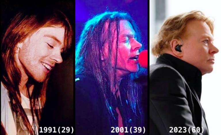 Axl Rose's Plastic Surgery Controversy